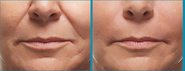 فیلر بهتر است یا بوتاکس | تفاوت تزریق بوتاکس و فیلر (ژل)