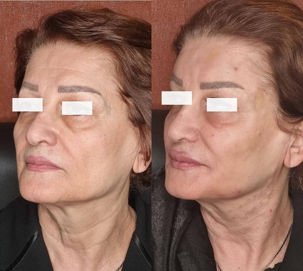 اندولیفت برای جوانسازی چگونه انجام می‌شود؟