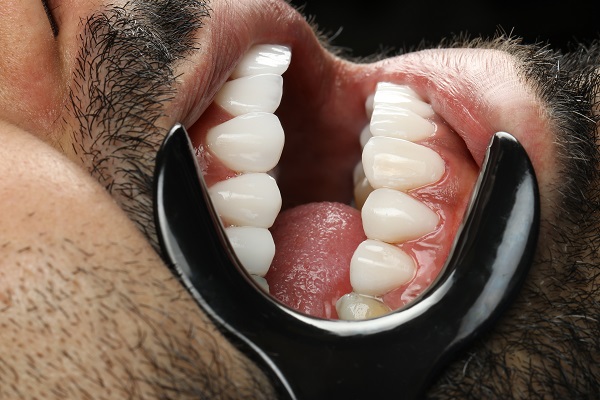 بهترین دندانپزشک زیبایی کامپوزیت ونیر کیست؟