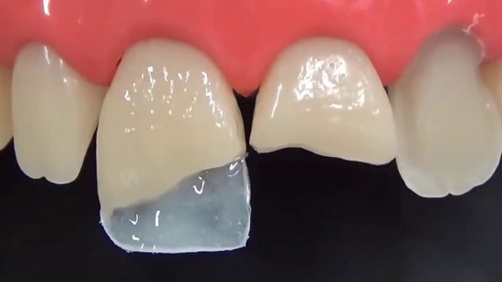 ترمیم دندان‌های جلو با چه روش‌هایی انجام می شود؟