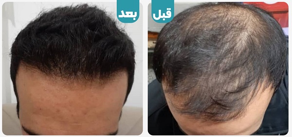 جراحی پیوند مو | انواع روش ها و هزینه