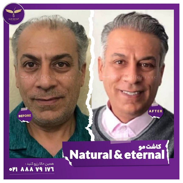 بهترین روش کاشت مو طبیعی با تراکم بالا + هزینه و نمونه کاشت 