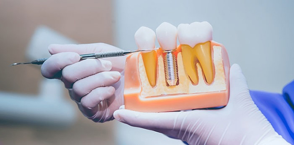 بستن فاصله بین دندان ها + پرکردن فاصله با روش های ارتودنسی، کامپوزیت و ...