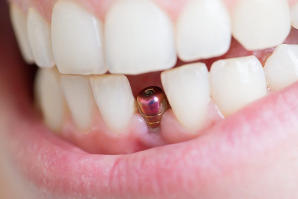 ایمپلنت فوری دندان در یک روز چیست؟ + مزایا، معایب و مراحل 