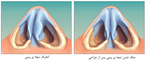 عمل جراحی انحراف بینی و شرایط آن