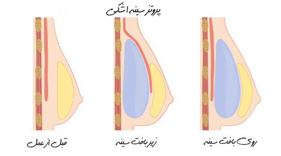 تفاوت پروتز سینه با لیفت سینه | آشنایی کامل با هر دو روش  جراحی سینه 