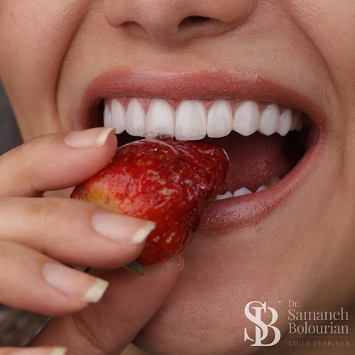 فرق کامپوزیت دندان با لمینت سرامیکی چیست؟ کدام یک بهتر است؟ 