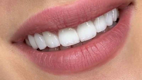 لمینت دندان فوری چیست؟