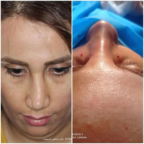 عمل جراحی ترمیم بینی توسط دکتر شاهین کریمیان + مزایا، معایب و هزینه