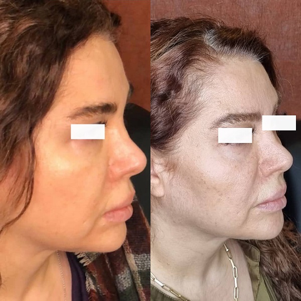 اندولیفت برای جوانسازی چگونه انجام می‌شود؟