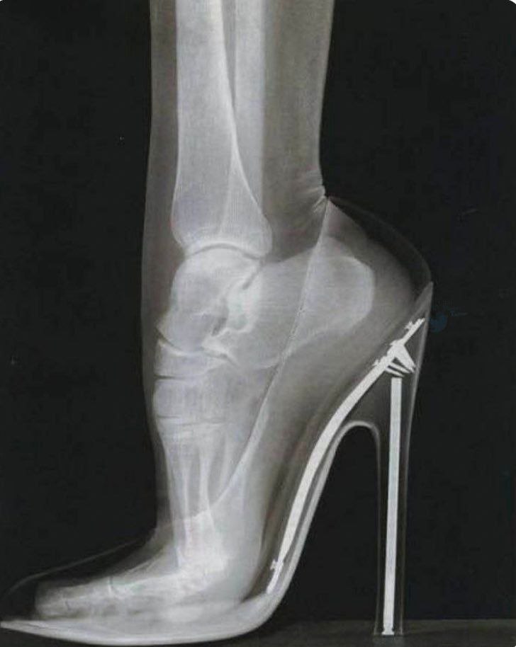 تصویر رادیوگرافی از درون پای انسان، وقتی کفش پاشنه بلند می‌پوشد