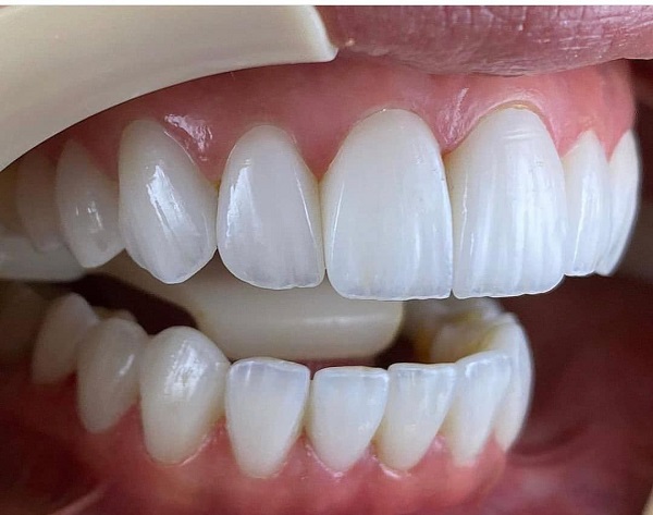 لمینت اقساطی و مزایای آن