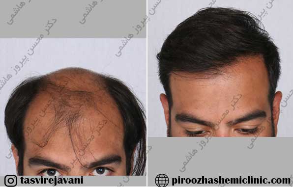 مجهزترین کلینیک کاشت مو در تهران