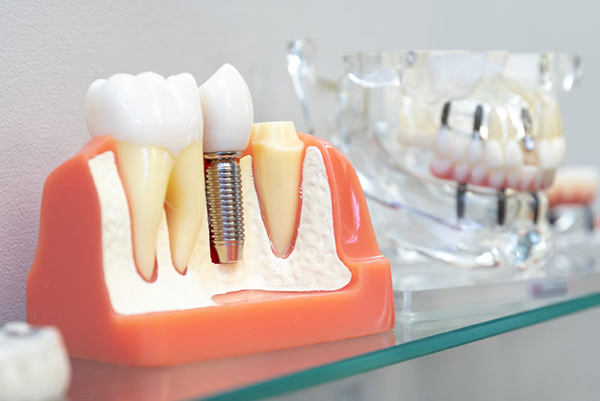 ایمپلنت دندان اشترومن سوئیسی چیست؟