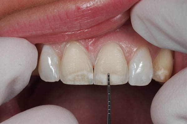 بررسی کامل مزایا و معایب لمینت دندان
