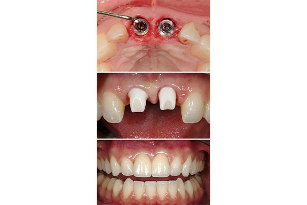 دندان مصنوعی با پایه ایمپلنت و مزایای آن