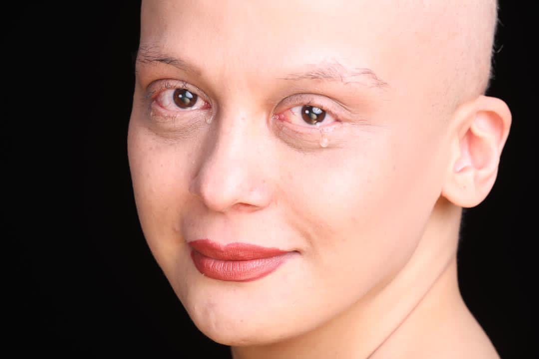 چهره غیرقابل‌ باور مارال فرجاد بعد از شیمی درمانی