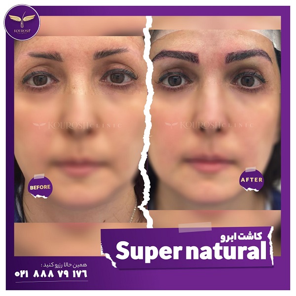 بهترین روش کاشت ابرو کدام است؟ | مراحل کاشت، ماندگاری، مزایا، معایب و هزینه