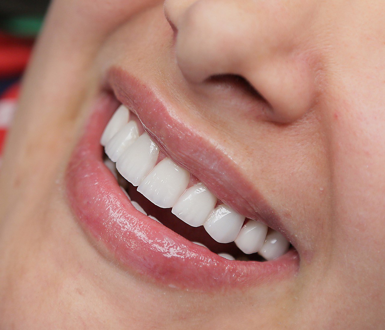 لمینت کریستالی دندان چیست و چه ویژگی‌هایی دارد؟