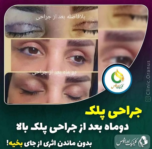 هزینه عمل بلفاروپلاستی (جراحی پلک) در سال 1402 