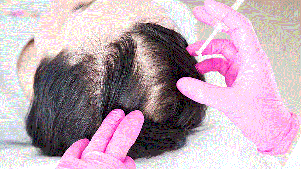 درمان ریزش مو با هیر فیلر چگونه انجام می‌شود؟