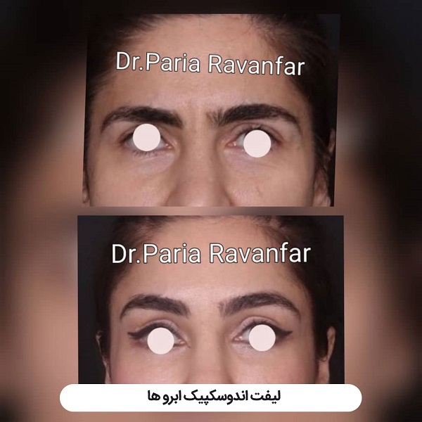 لیفت شقیقه با جراحی و هر آنچه باید درباره آن بدانید