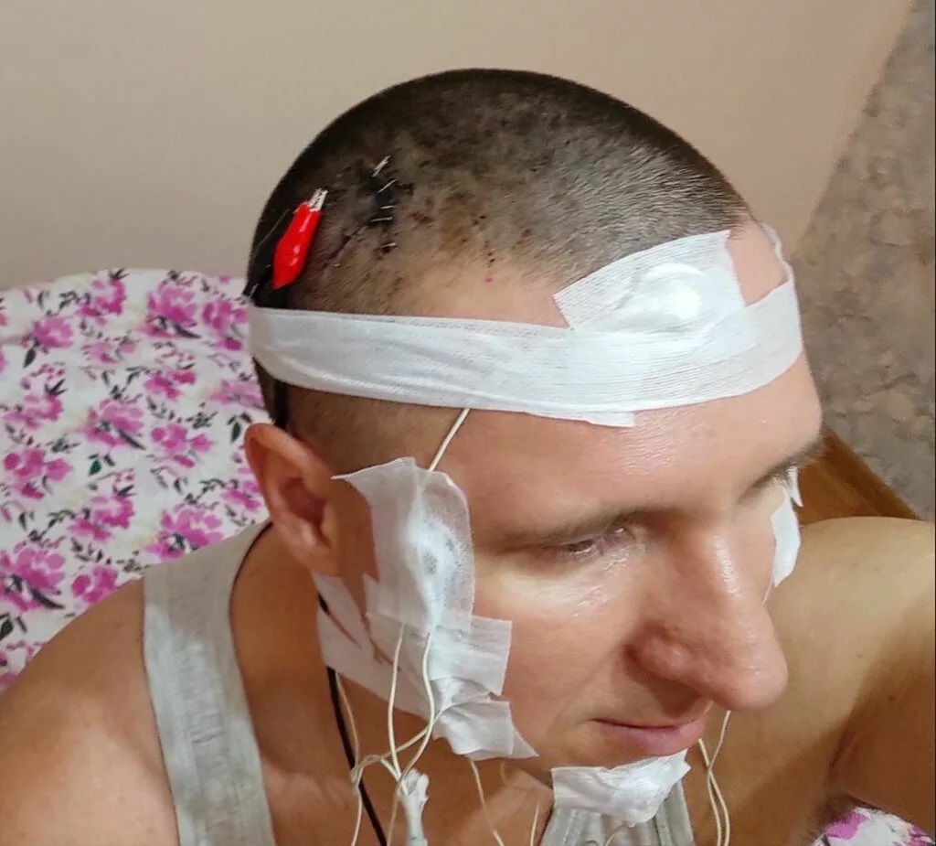محقق روسی برای کاشت تراشه، جمجمه‌اش را سوراخ کرد 