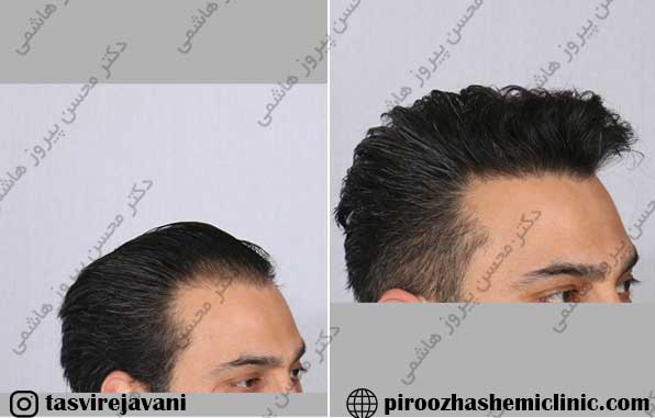 مجهزترین کلینیک کاشت مو در تهران