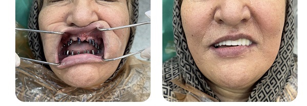 ایمپلنت ارزان دندان در تهران و تفاوت آن با ایمپلنت گران
