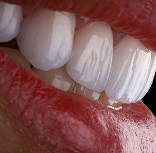 لمینت دندان اقساطی (شرایط پیش پرداخت و قسط)