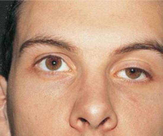 افتادگی پلک (پتوز) چیست؟ پتوز پلک چشم چگونه درمان می شود؟