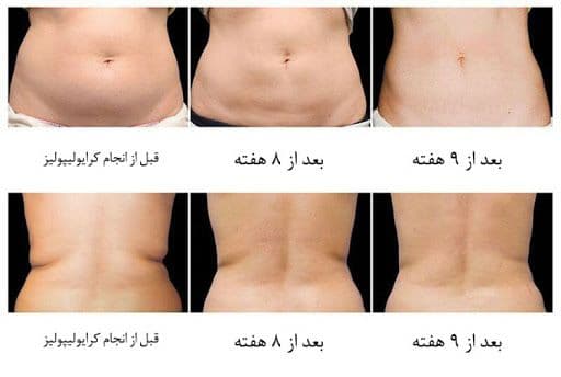 راه ‌حل چاقی موضعی چیست؟