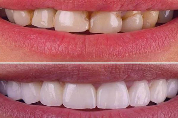 مزایا و معایب لمینت دندان + راه های جلوگیری از عوارض لمینت دندان