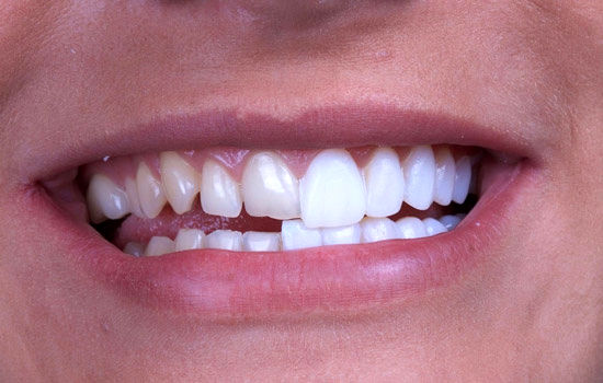 لمینت دندان های جلو و هزینه آن چقدر است؟