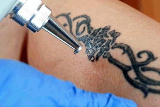 لیزر کیوسوئیچ چیست و چگونه انجام می‌شود؟