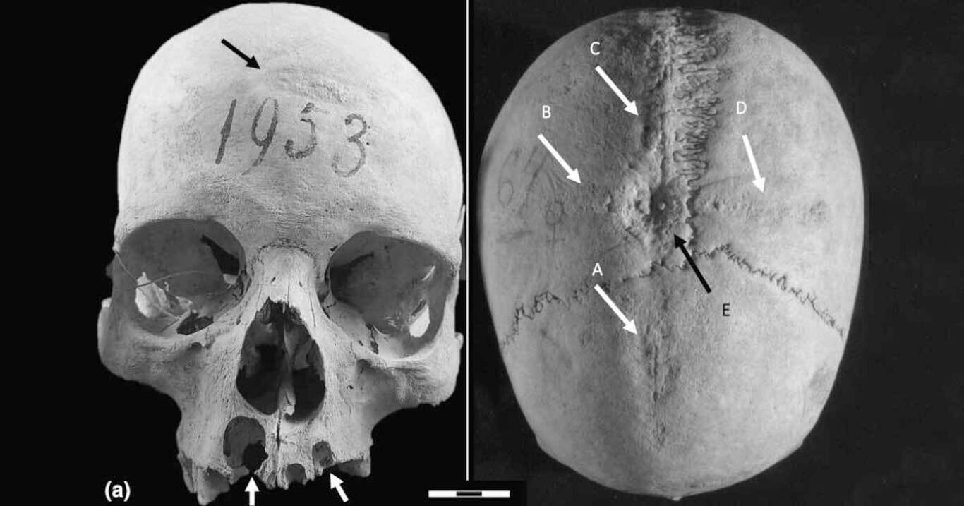 کشف شواهدی از جراحی مغز روی جمجمۀ ۱۳۰۰ساله