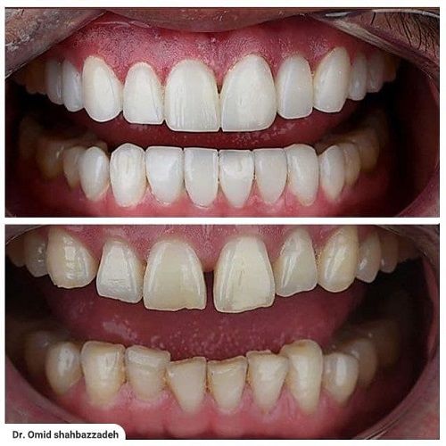 بررسی کامل انواع لمینت دندان + مزایا و معایب