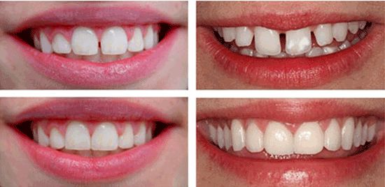 بستن فاصله بین دندان ها با 10 روش مختلف